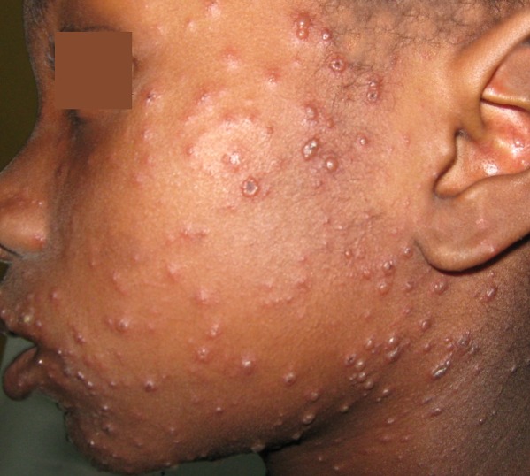 Chickenpox Outbreak at Hindsey Junior School NOW Grenada Chickenpox Outbreak at Hindsey Junior School NOW Grenada